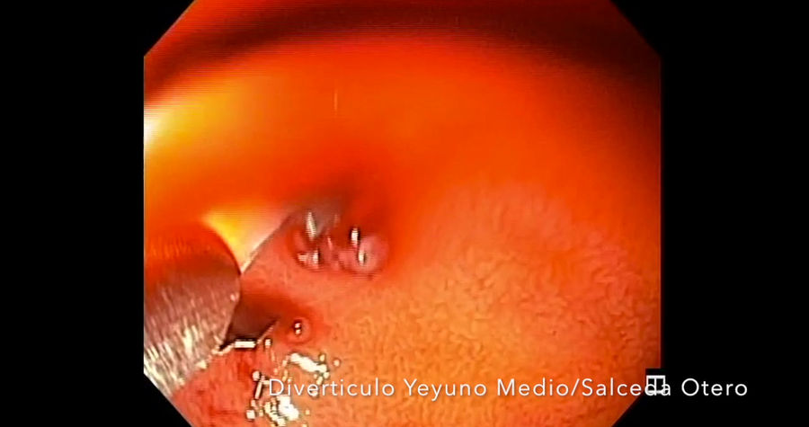 Enteroscopia_Sangrado Yeyuno Medio